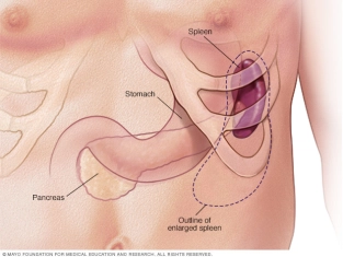 Illustration of Splenomegaly Quiz